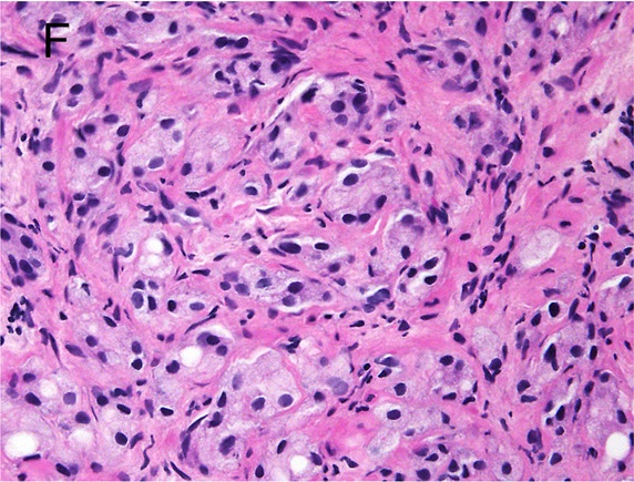 Prostatakarzinom 
Gleason-Pattern 4
Prostatakarzinom mit abortivem drüsigem Wuchsmuster